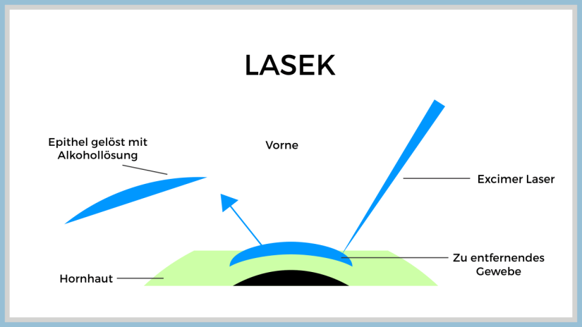 LASEK-Methode