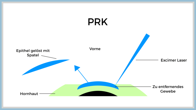 PRK Methode