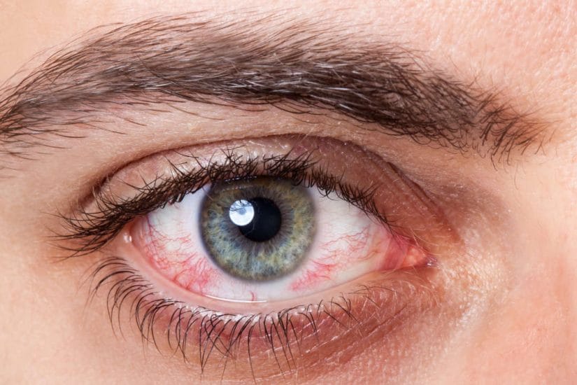 Augenlasern Entzündung