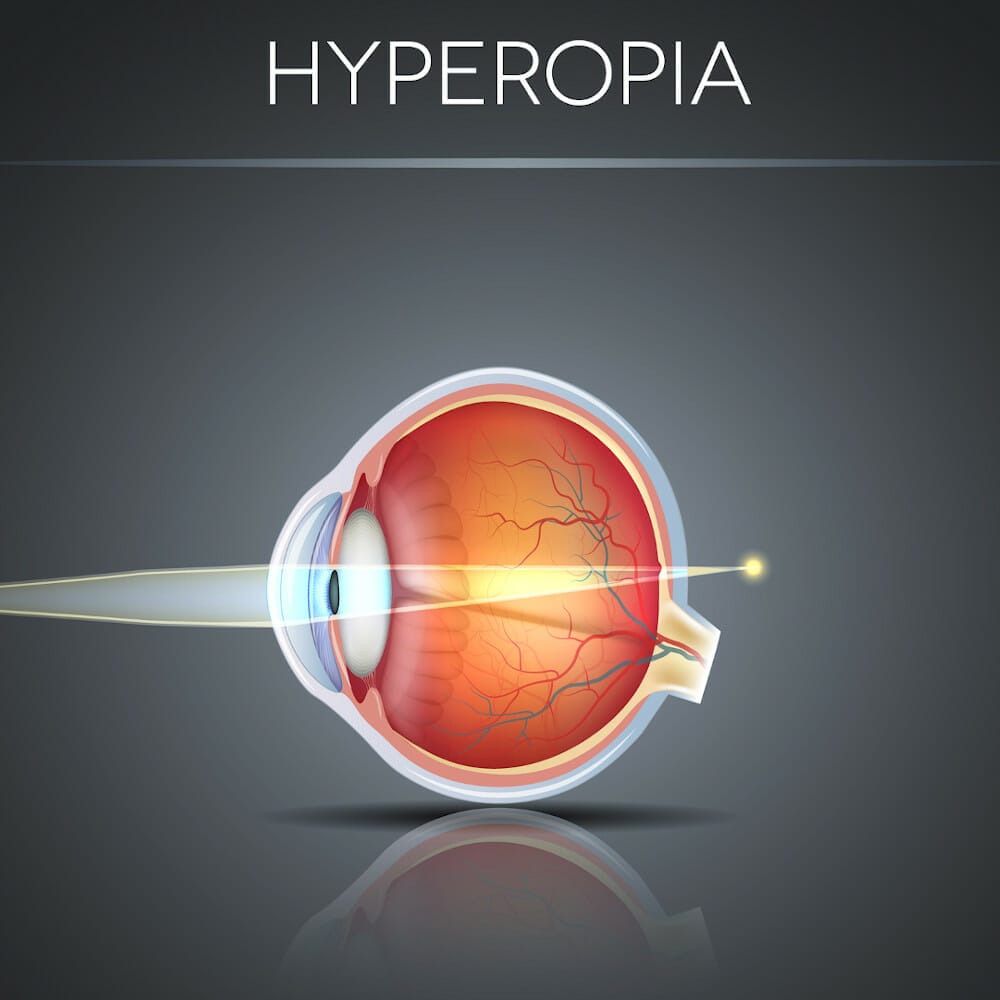 Weitsichtigkeit lasern Methoden & Kosten der